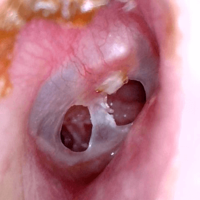 eardrum perforation